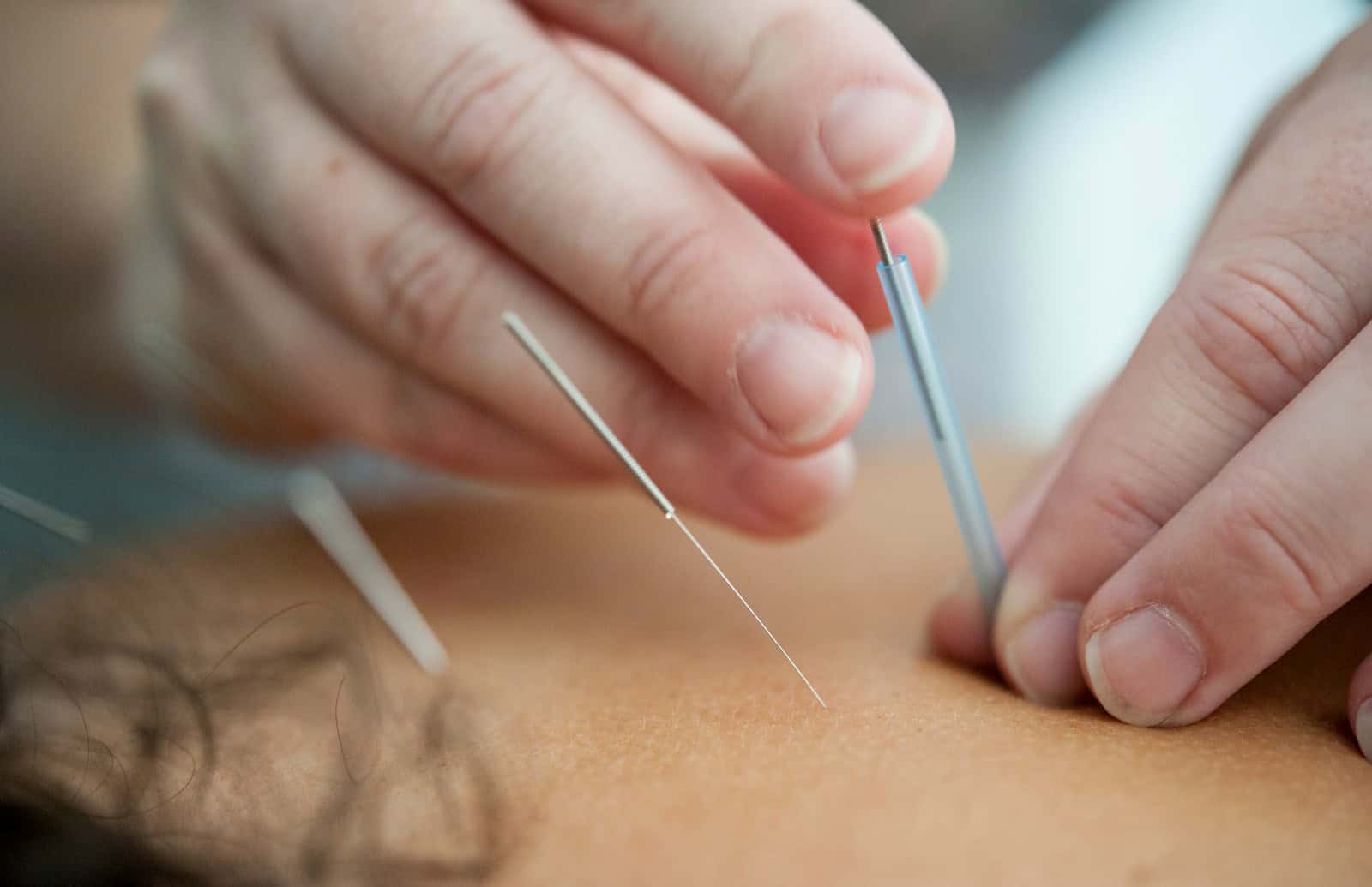 Aiguille d'acupuncture claire pour traitement, centrée sur une intervention précise sur la peau, illustrant la médecine alternative et les soins de santé.