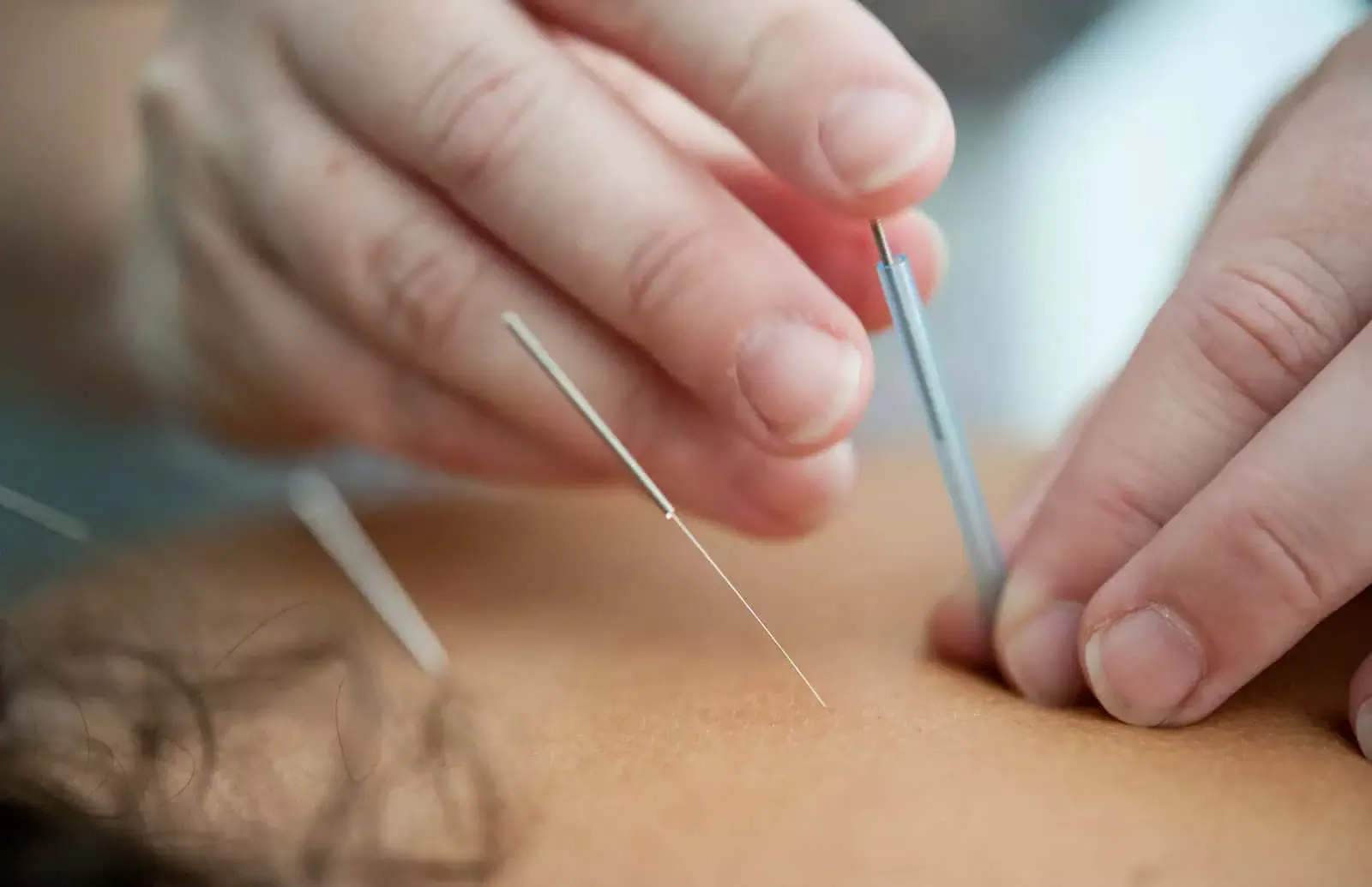 Aiguille d'acupuncture claire pour traitement, centrée sur une intervention précise sur la peau, illustrant la médecine alternative et les soins de santé.